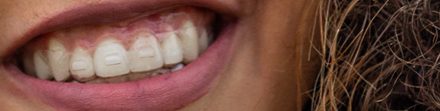 Clear braces on a girl's teeth